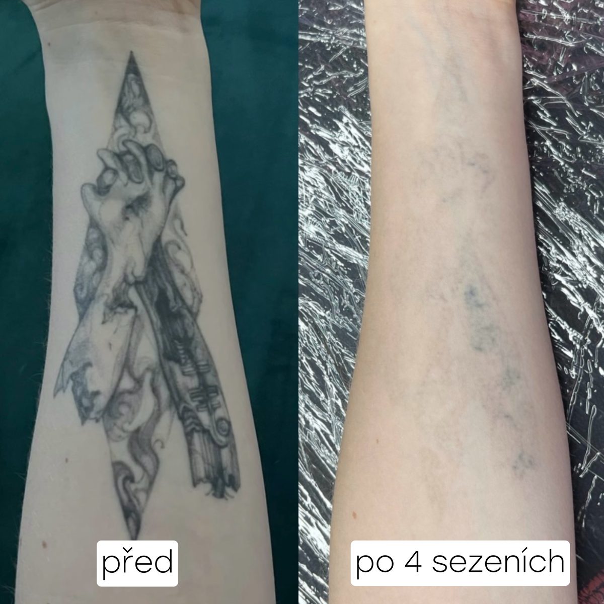 Odstranění tetování na předloktí – před a po