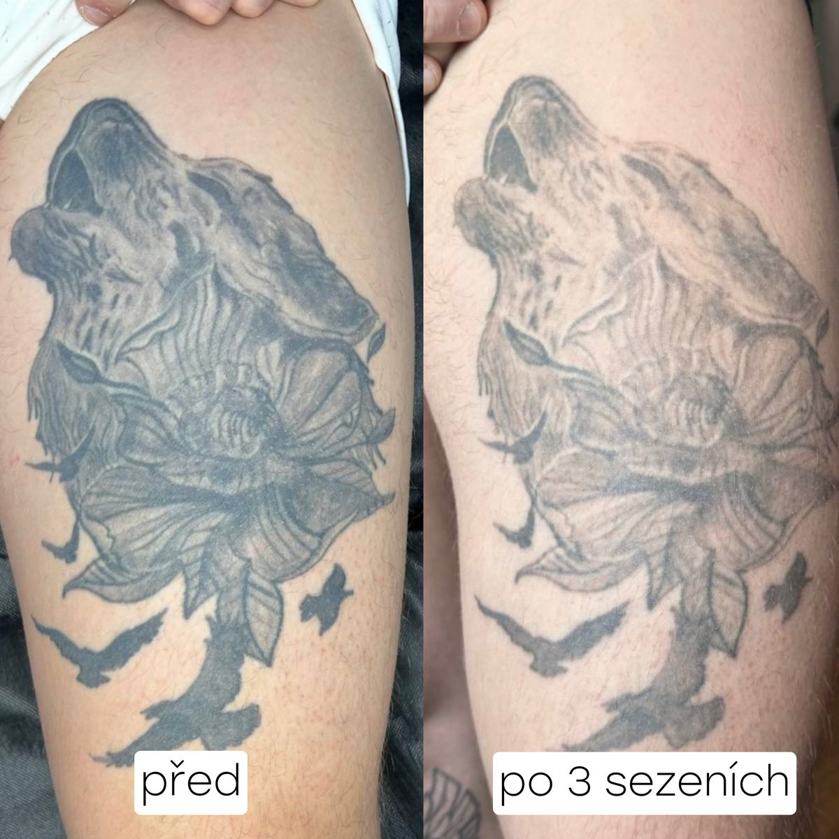 Odstranění tetování na stehně – před a po