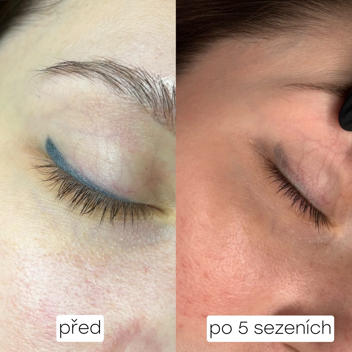 Odstranění PMU očních víček – před a po
