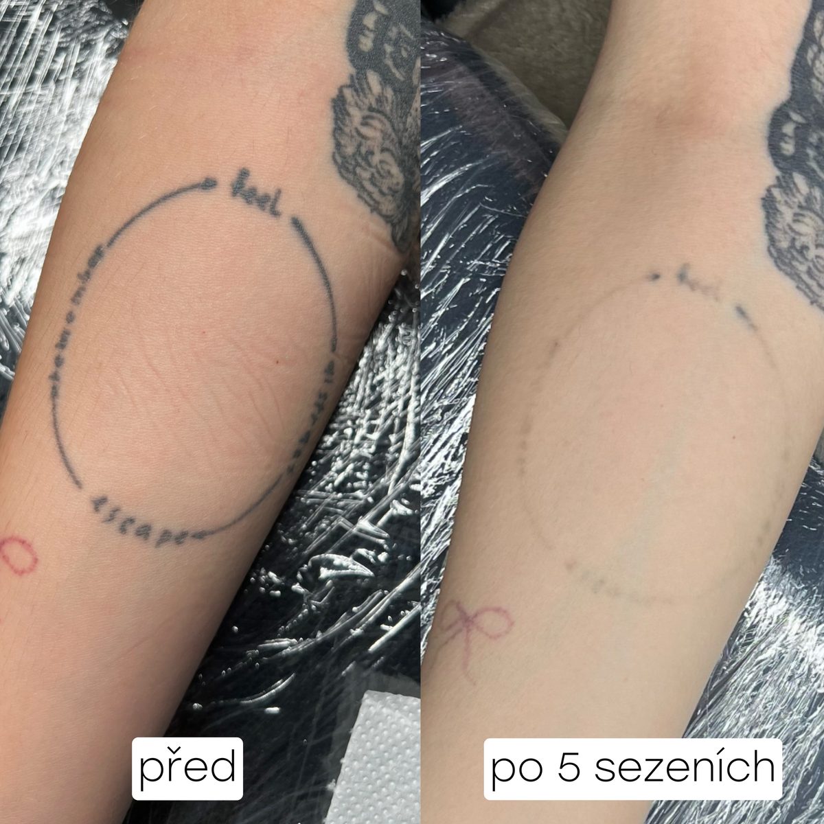 Odstranění tetování na předloktí – před a po