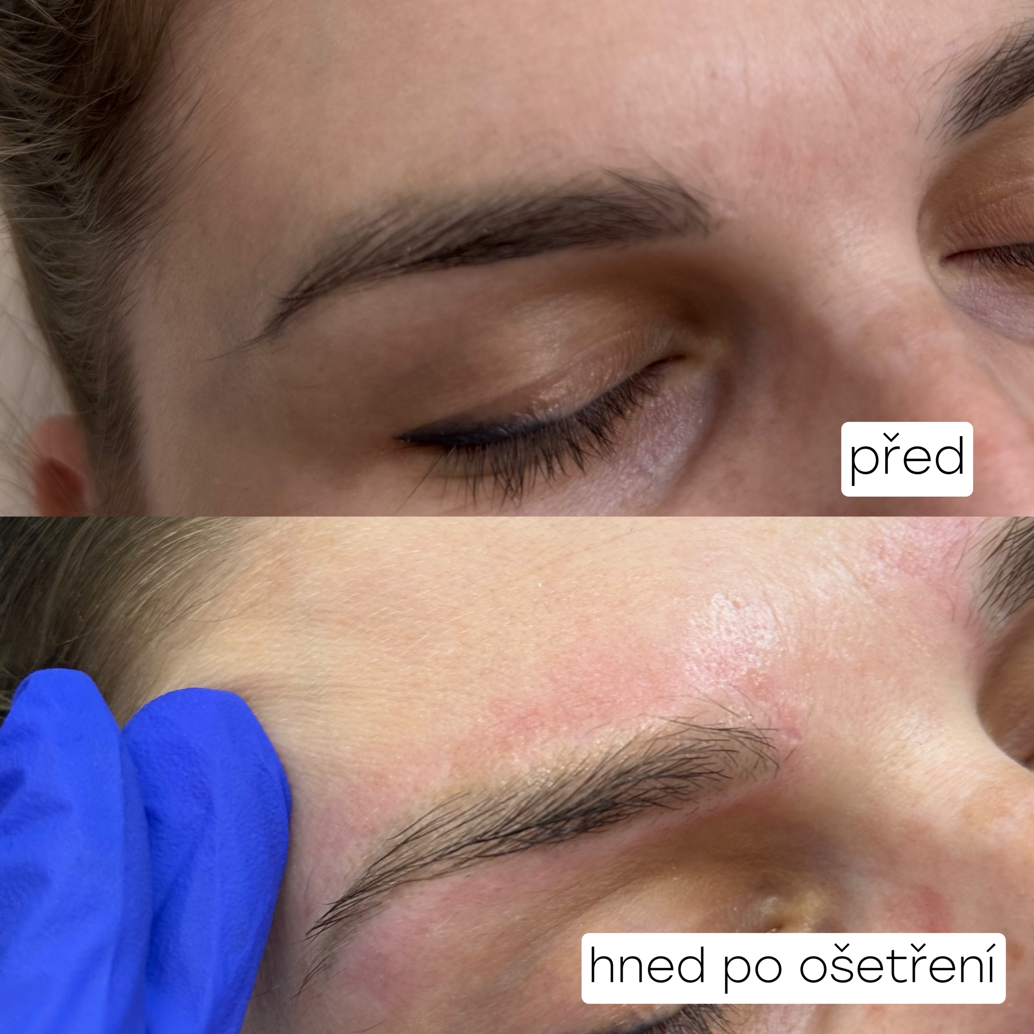 Odstranění PMU obočí – hned po ošetření