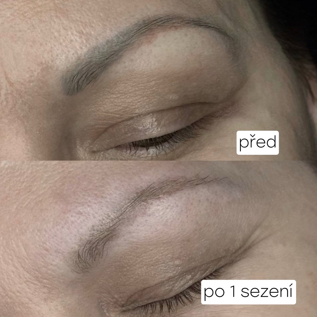 Odstranění PMU obočí – po jednom sezení